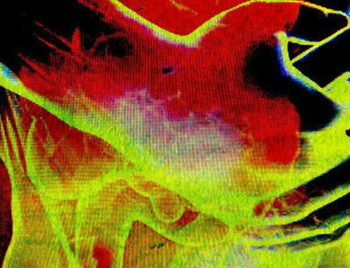 Abdominal Pain and Bloating